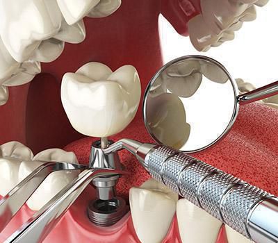 Dental Implants Dental Implants
